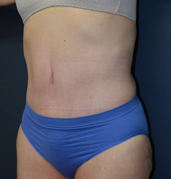 Abdominoplasty