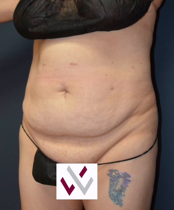 Abdominoplasty