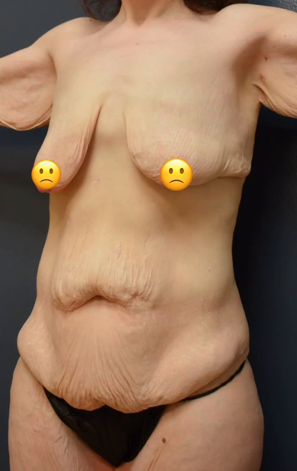 Abdominoplasty