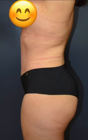 Abdominoplasty