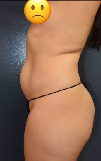 Abdominoplasty