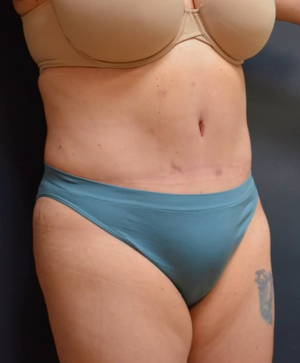 Abdominoplasty