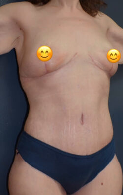 Abdominoplasty