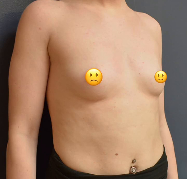 Breast Augmentation