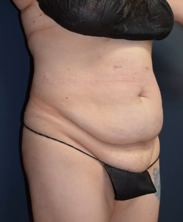 Abdominoplasty