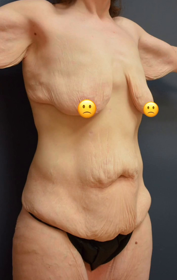 Abdominoplasty