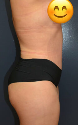 Abdominoplasty
