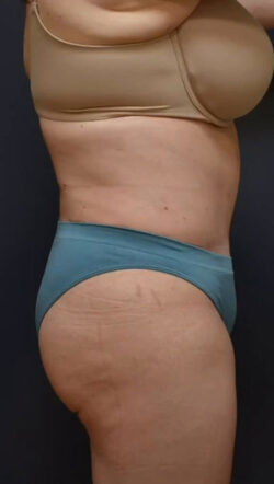 Abdominoplasty