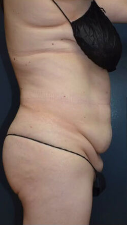 Abdominoplasty