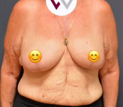 Breast Cancer Surgery