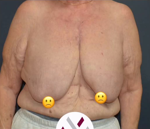 Breast Cancer Surgery