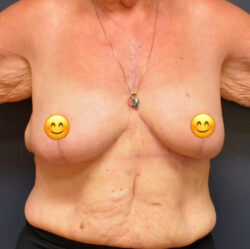 Breast Cancer Surgery