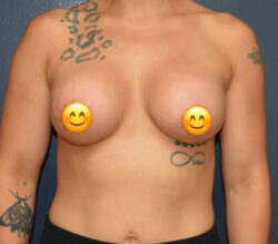 Breast Augmentation