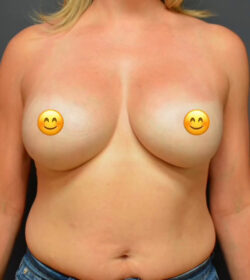 Breast Augmentation