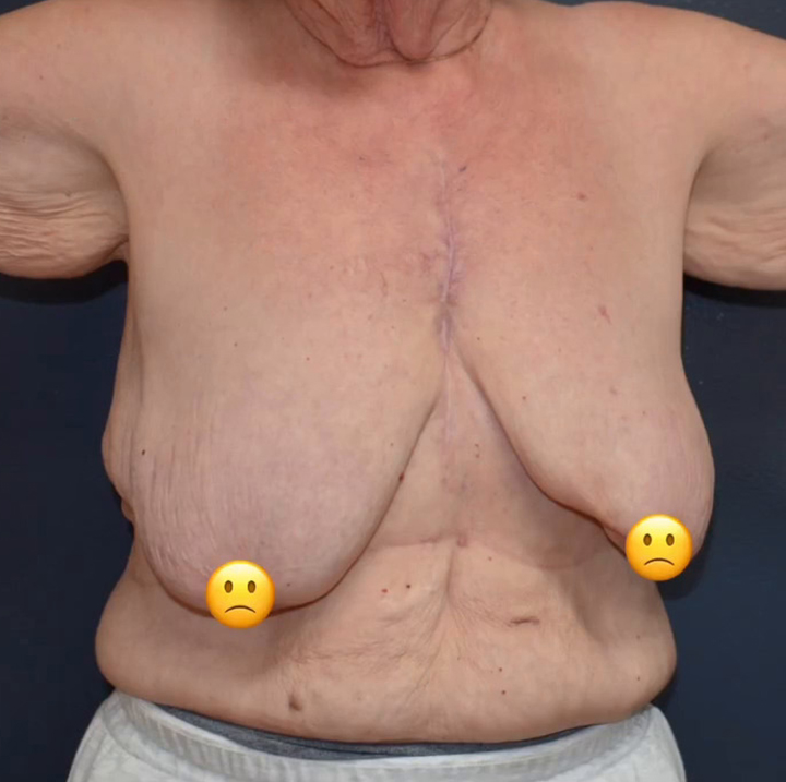 Breast Cancer Surgery