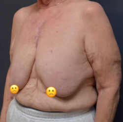 Breast Cancer Surgery