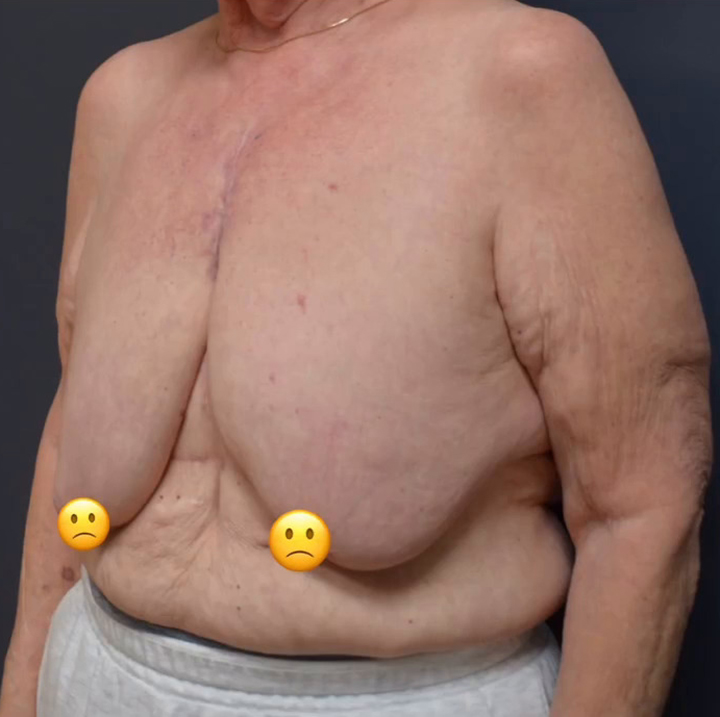 Breast Cancer Surgery