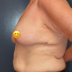 Breast Cancer Surgery