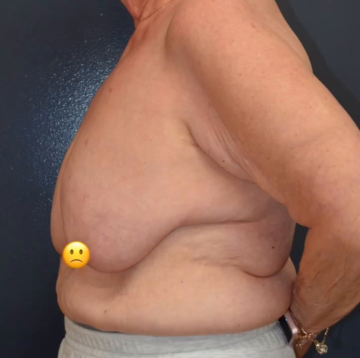 Breast Cancer Surgery