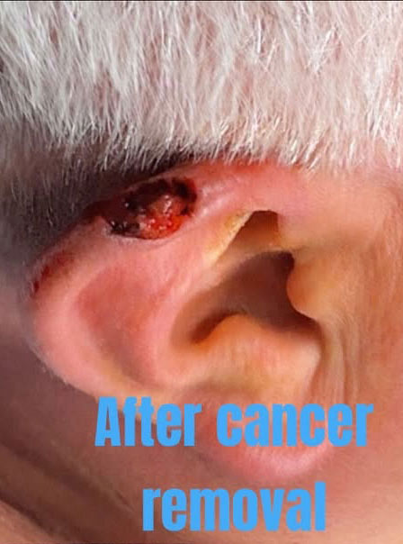 Skin Cancer Treatment