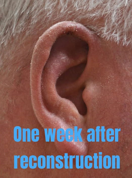 Skin Cancer Treatment