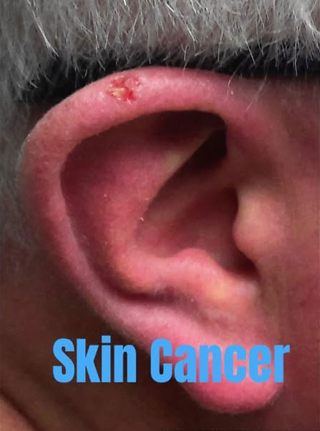 Skin Cancer Treatment