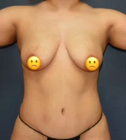 Breast Lift