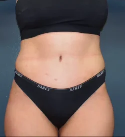 Abdominoplasty