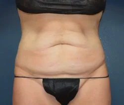Abdominoplasty