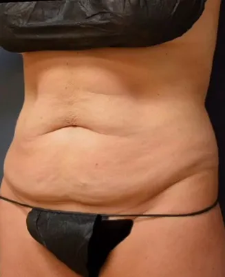 Abdominoplasty