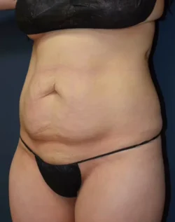 Abdominoplasty