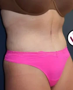Abdominoplasty