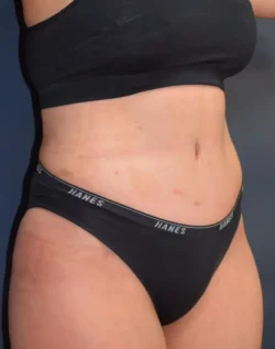Abdominoplasty