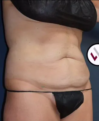 Abdominoplasty