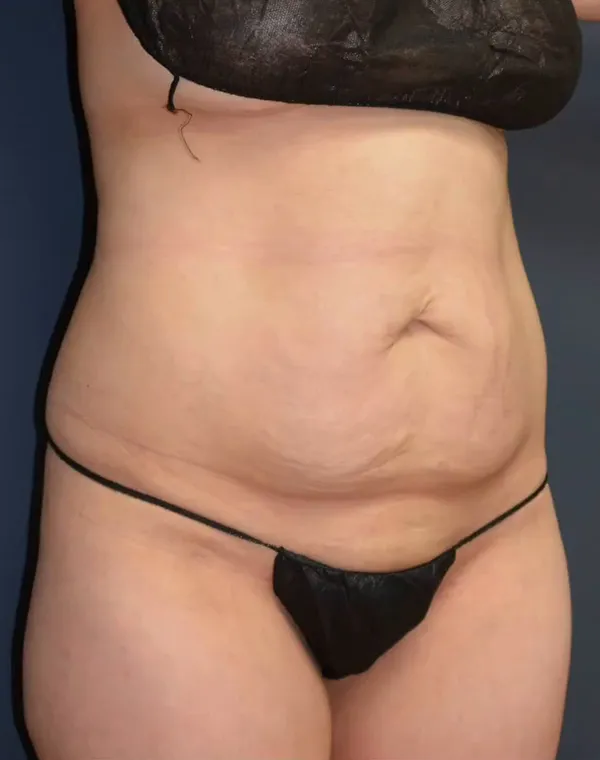 Abdominoplasty