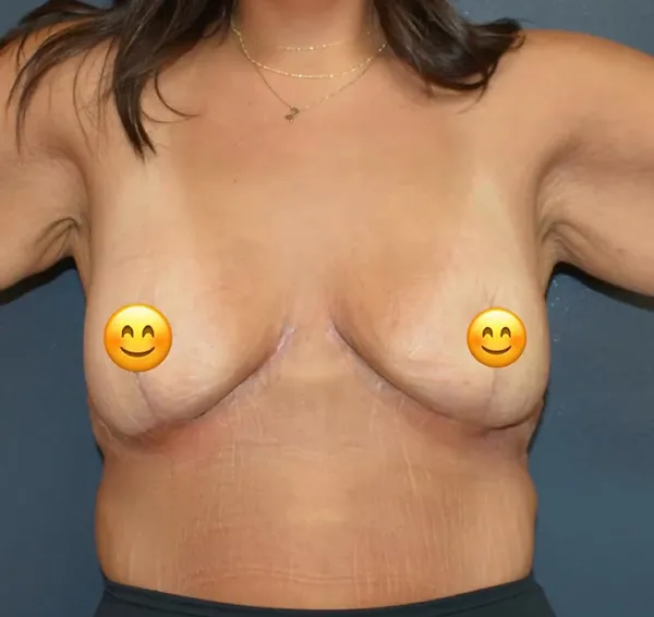 Breast Lift