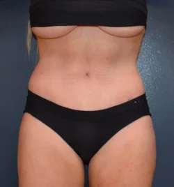 Abdominoplasty