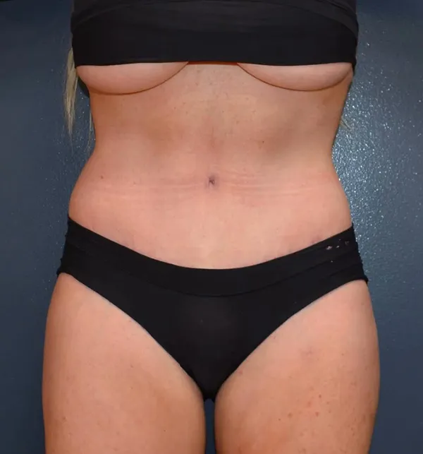 Abdominoplasty Case 29989 After Photo Abdominoplasty