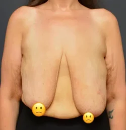 Breast Reduction