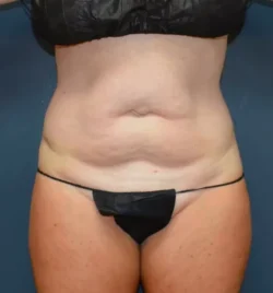 Abdominoplasty