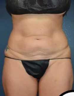 Abdominoplasty