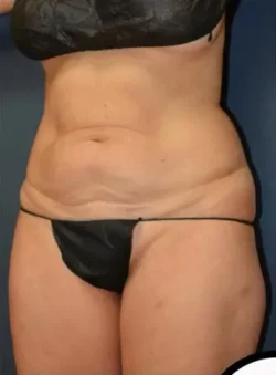 Abdominoplasty