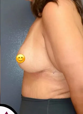Breast Lift