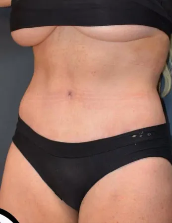 Abdominoplasty