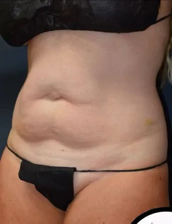Abdominoplasty
