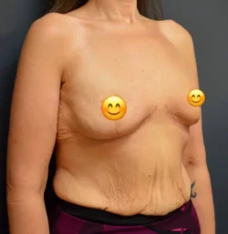 Breast Reduction