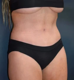 Abdominoplasty