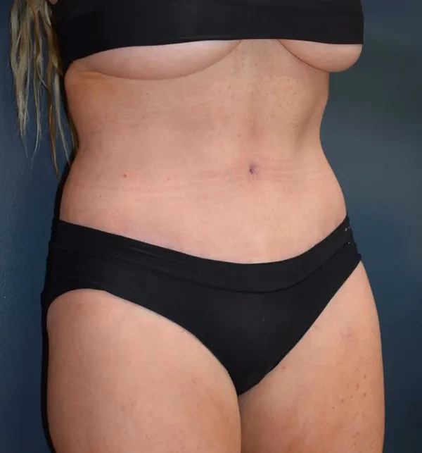 Abdominoplasty