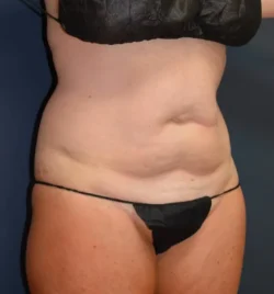 Abdominoplasty