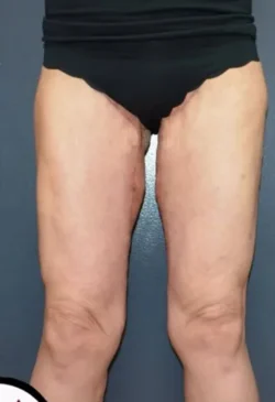 Thigh Lift
